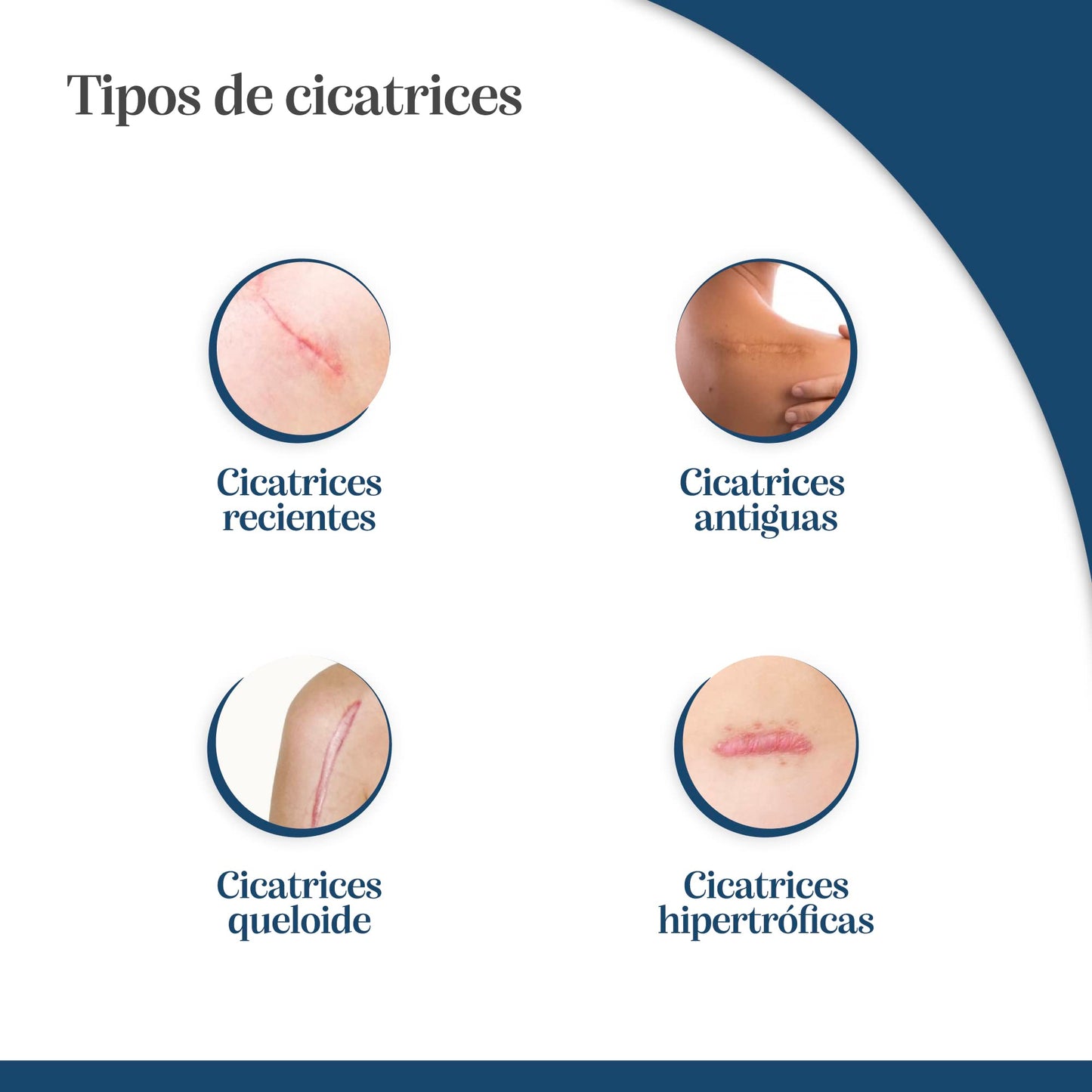 Trofolastin - Reductor de Cicatrices Hipertróficas y Queloides, 5x7,5 cm, 5 Uds