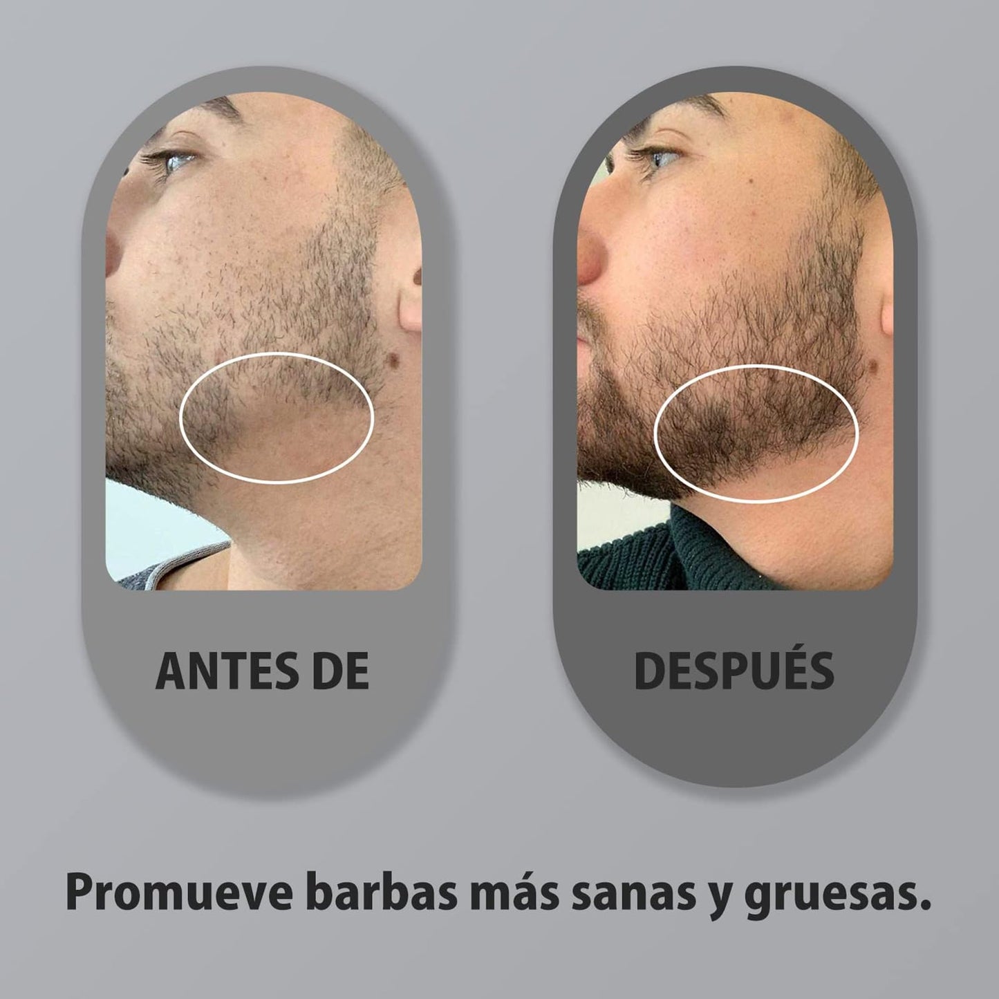 Dermaroller 0.5mm Titanio para Cabello y Barba - KOI Beauty