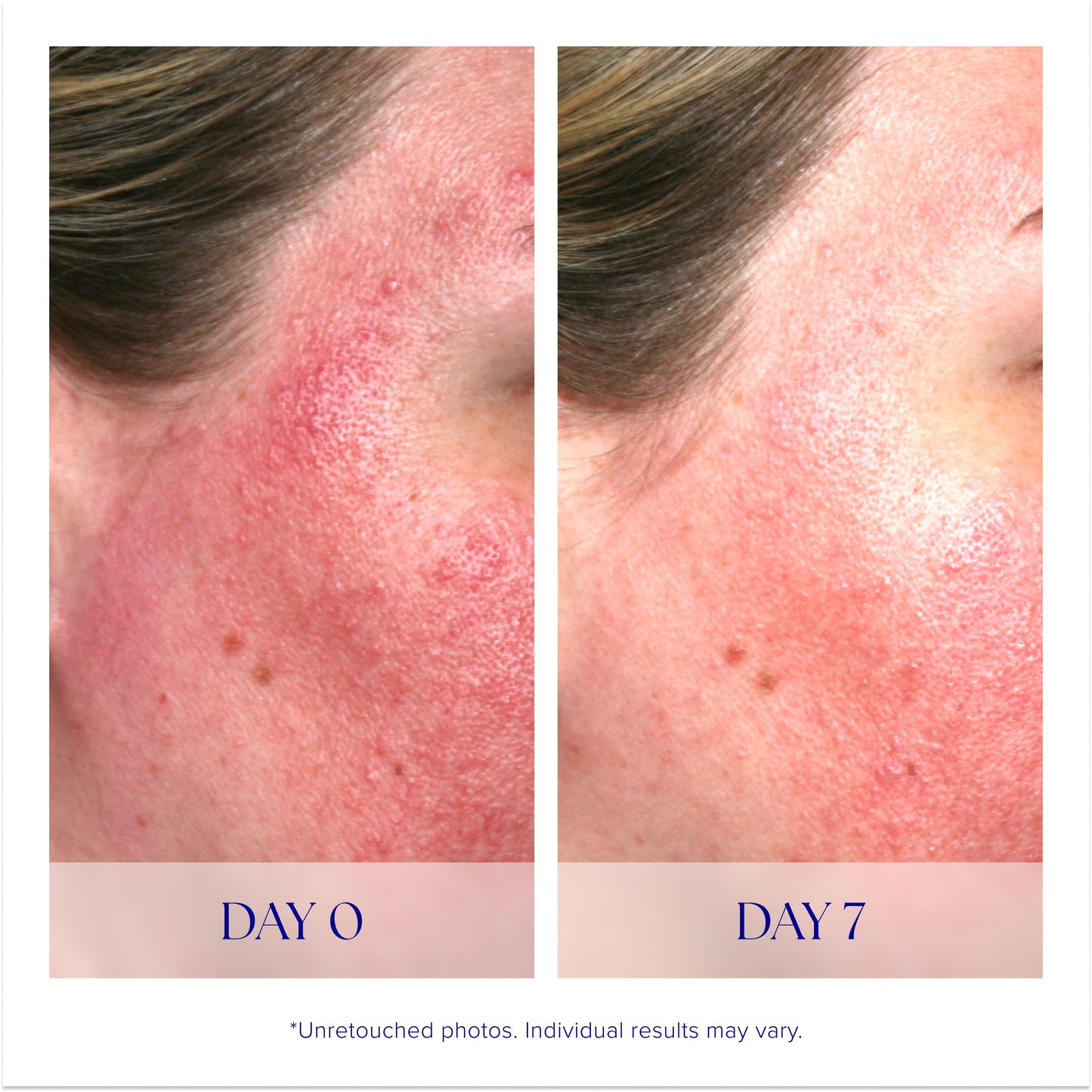 iS Clinical Pro-Heal Serum Advance+ Antioxidant Rich Serum Containing Vitamin C, E & A for Redness, Rosacea, Inflammation, 1 fl oz