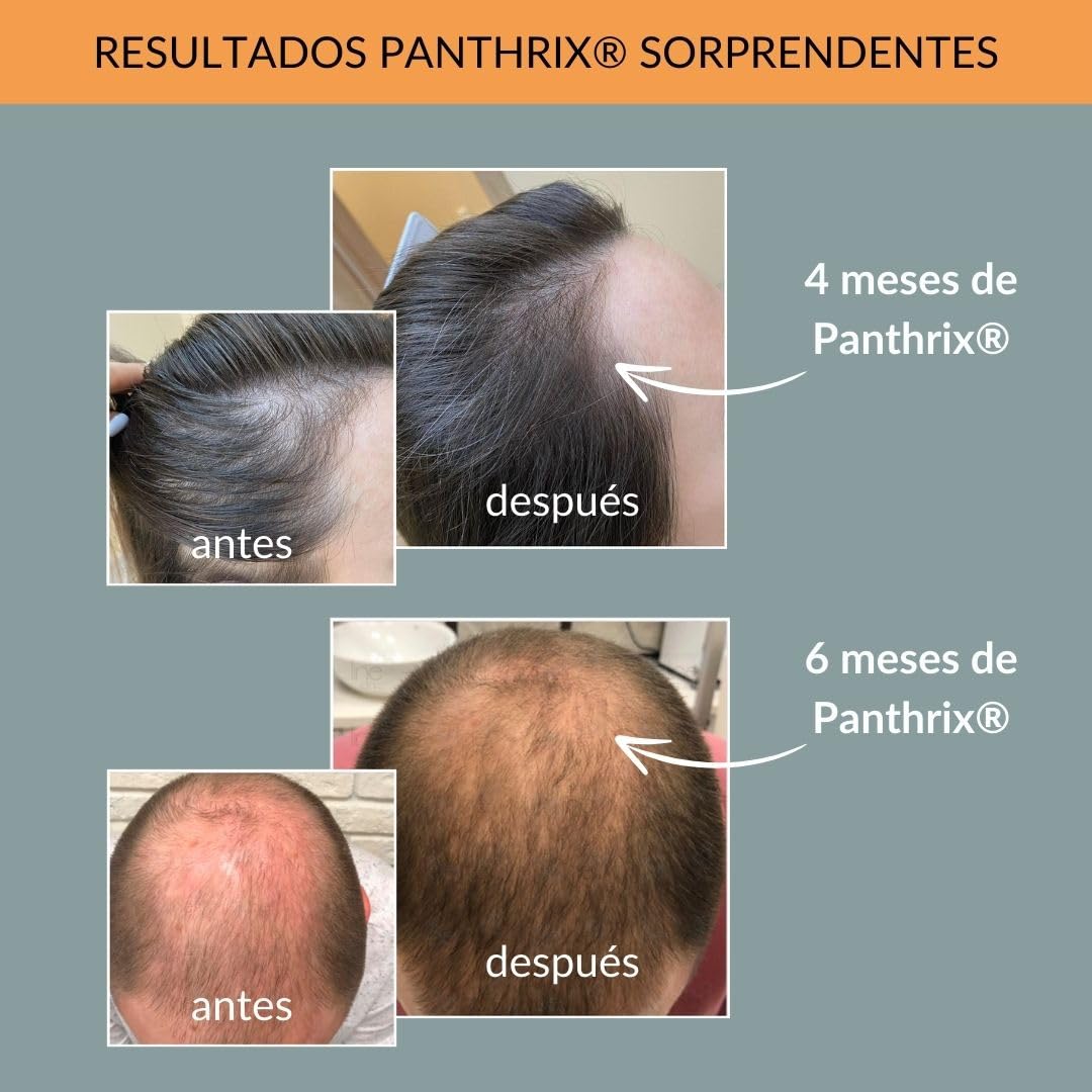 Panthrix - Activador del Crecimiento del Cabello - Ingrediente Activo - 100 ml de Spray Alta Dosis - Tónico para el Crecimiento Rápido del Pelo - para Hombres y Mujeres